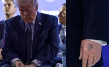 Trump explains bruises on his arm
