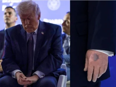 Trump explains bruises on his arm