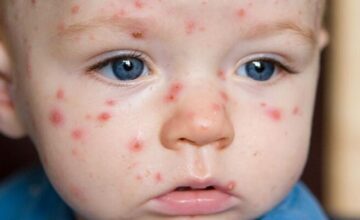Chickenpox disease is spreading among children – VIDEO