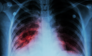 Last year, 198 children and adolescents contracted tuberculosis