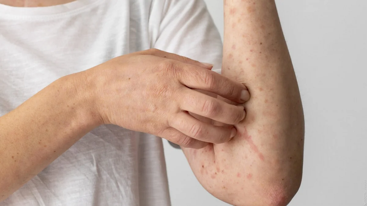 An increase in measles and chickenpox cases has been observed in Azerbaijan in the first five months of this year