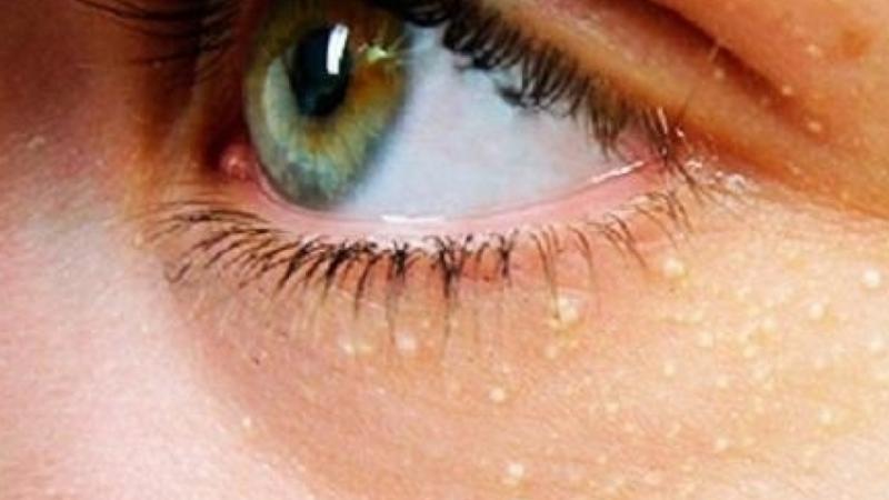 This sign on the face indicates a risk of heart attack and stroke