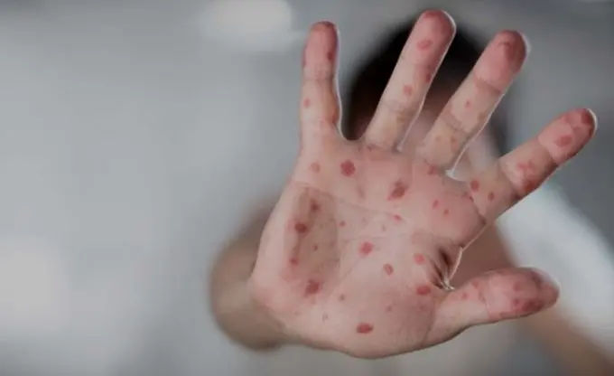 Urgent measures taken against measles threat in Uzbekistan
