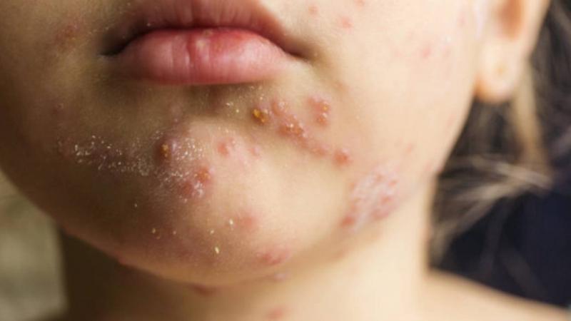Number of children suspected of measles in Bangladesh reaches 1201