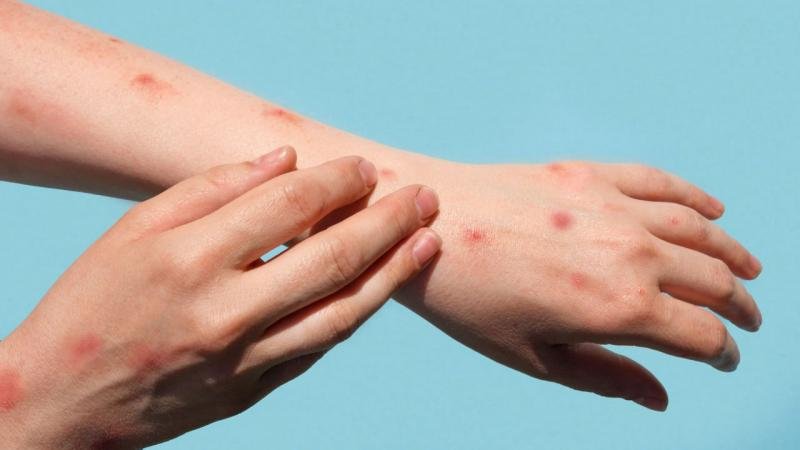 Current Situation of Monkeypox in Azerbaijan